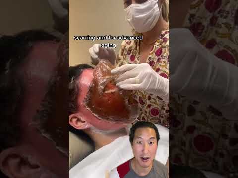 Off With Their Heads — Watch Her Skin Get Lifted Off Her Face! #phenol #chemicalpeel