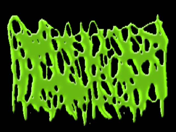 Hydrocephalus